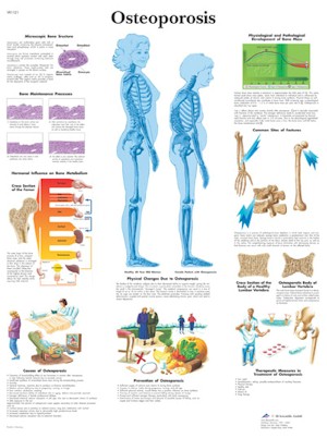 Wandkaart: Osteoporosis