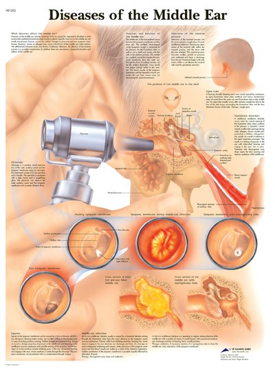 Wandkaart: Diseases Of The Middle Ear