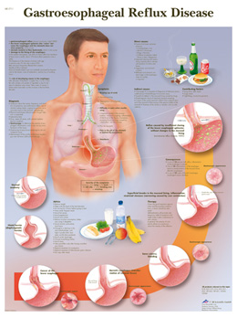 Wandkaart: Gastroesophageal Reflux Disease